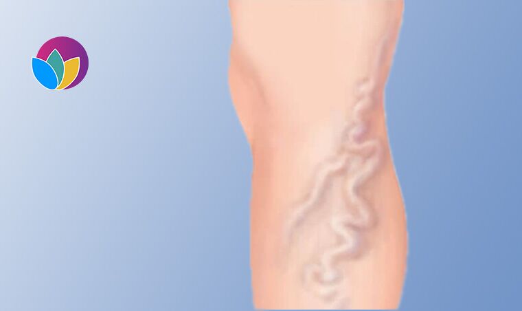 Varicose Veins Treatment