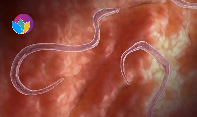 Trichinosis Treatment丨Relieve Parasites Infection & Get Rid of Body Discomfort